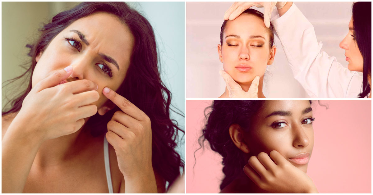 Sufrí de acné en mis ventitantos y así me deshice de él