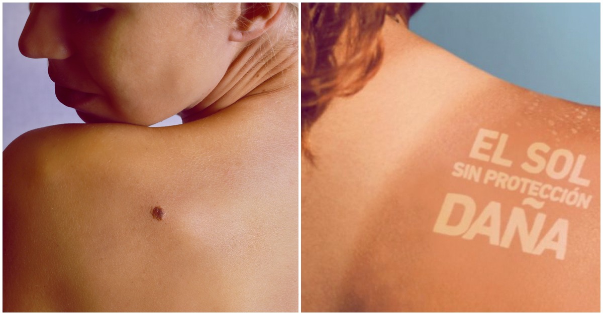 Tips para prevenir el cáncer de piel