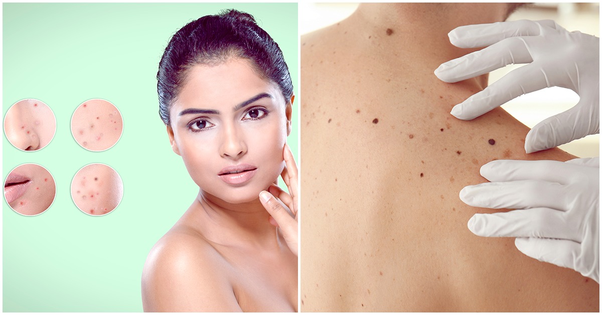 Señales para identificar si un lunar es maligno