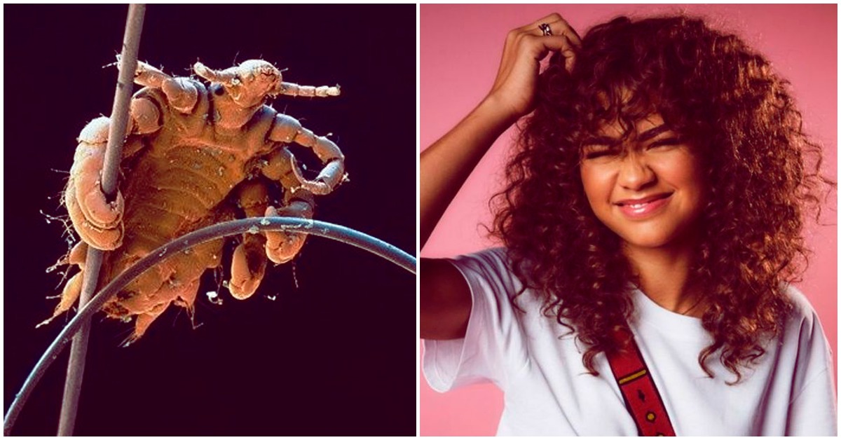 Cómo prevenir la pediculosis en época de calor