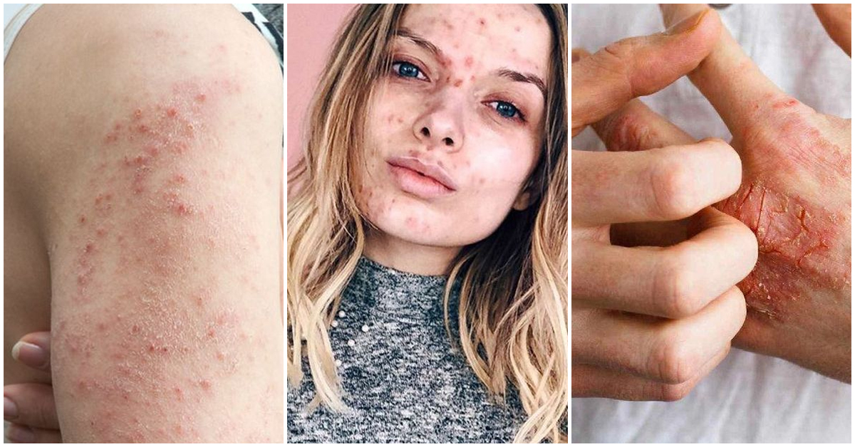 Las consecuencias que trae el estrés a tu piel