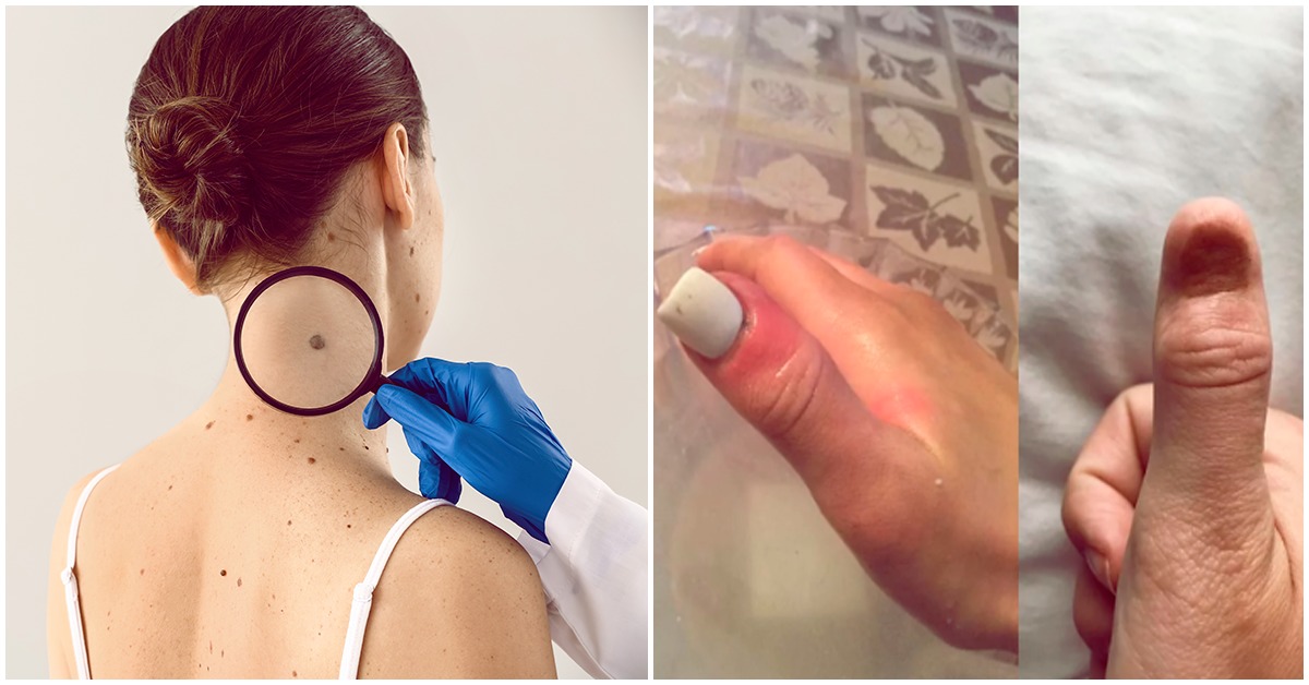 Contusiones en las uñas que podrían indicar cáncer de piel